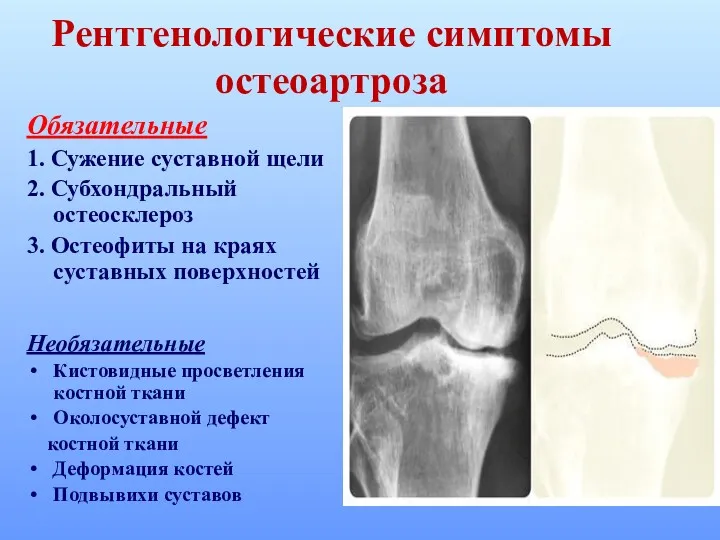 Рентгенологические симптомы остеоартроза Обязательные 1. Сужение суставной щели 2. Субхондральный
