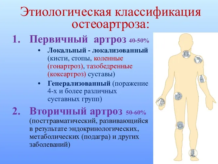 Этиологическая классификация остеоартроза: Первичный артроз 40-50% Локальный - локализованный (кисти,