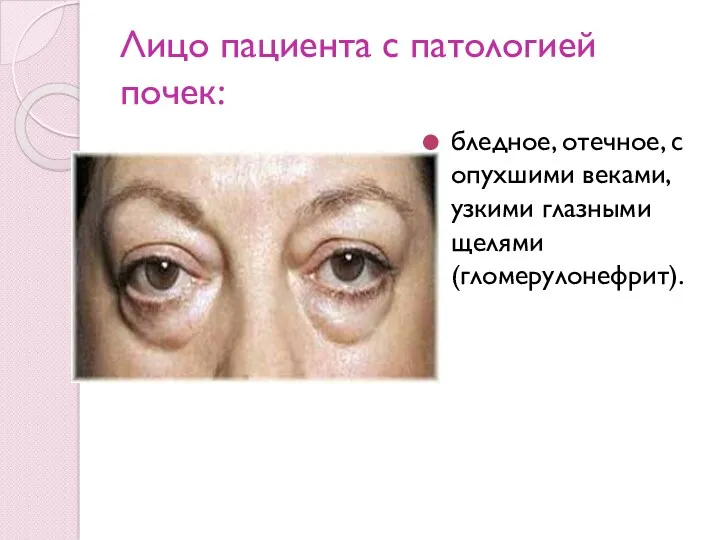 Лицо пациента с патологией почек: бледное, отечное, с опухшими веками, узкими глазными щелями(гломерулонефрит).