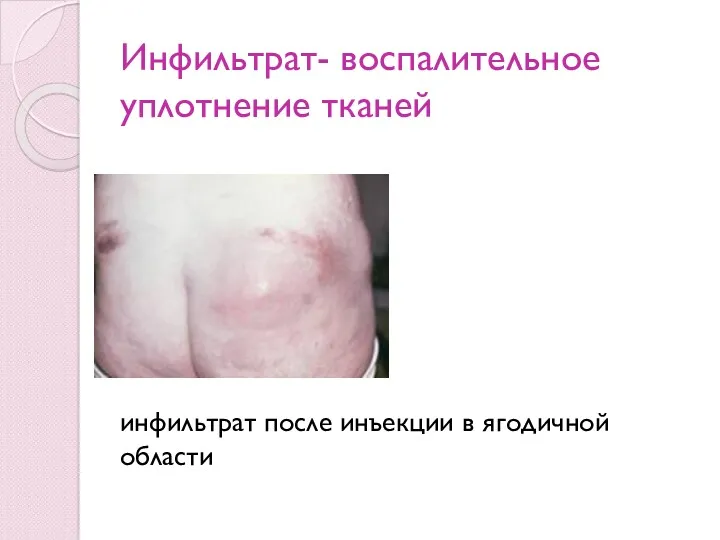 Инфильтрат- воспалительное уплотнение тканей инфильтрат после инъекции в ягодичной области