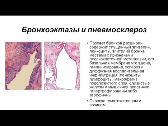 Бронхоэктазы и пневмосклероз Просвет бронхов расширен, содержит слущенный эпителий, лейкоциты, эпителий бронха местами