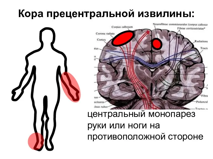 Кора прецентральной извилины: центральный монопарез руки или ноги на противоположной стороне