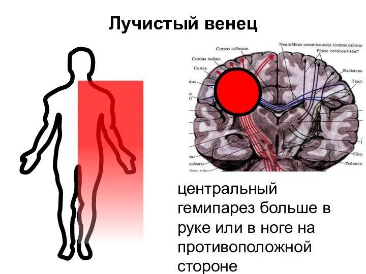 Лучистый венец центральный гемипарез больше в руке или в ноге на противоположной стороне