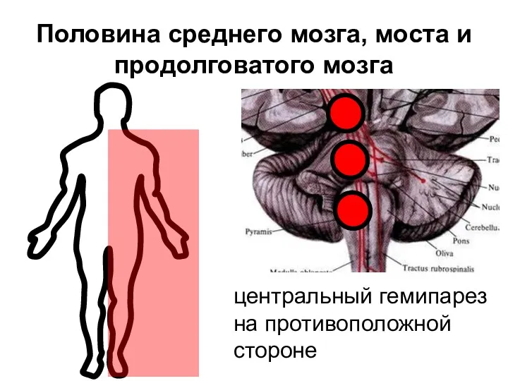 Половина среднего мозга, моста и продолговатого мозга центральный гемипарез на противоположной стороне