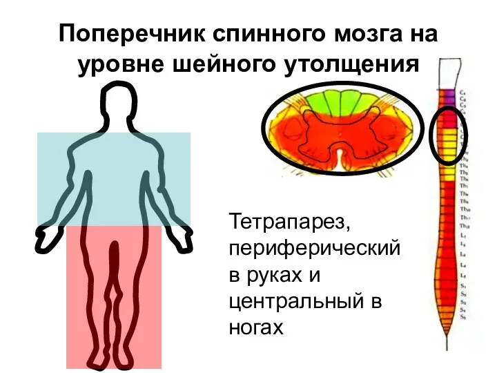 Поперечник спинного мозга на уровне шейного утолщения Тетрапарез, периферический в руках и центральный в ногах