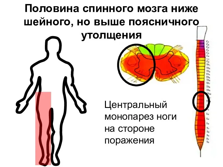 Половина спинного мозга ниже шейного, но выше поясничного утолщения Центральный монопарез ноги на стороне поражения
