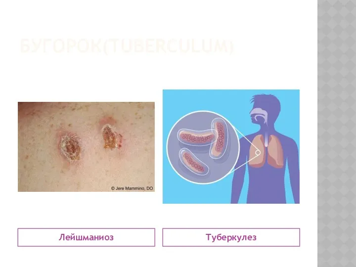 БУГОРОК(TUBERCULUM) Лейшманиоз Туберкулез