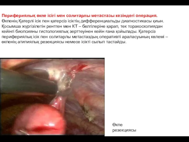 Перифериялық өкпе ісігі мен солитарлы метастазы кезіндегі операция. Өкпенің Қатерлі
