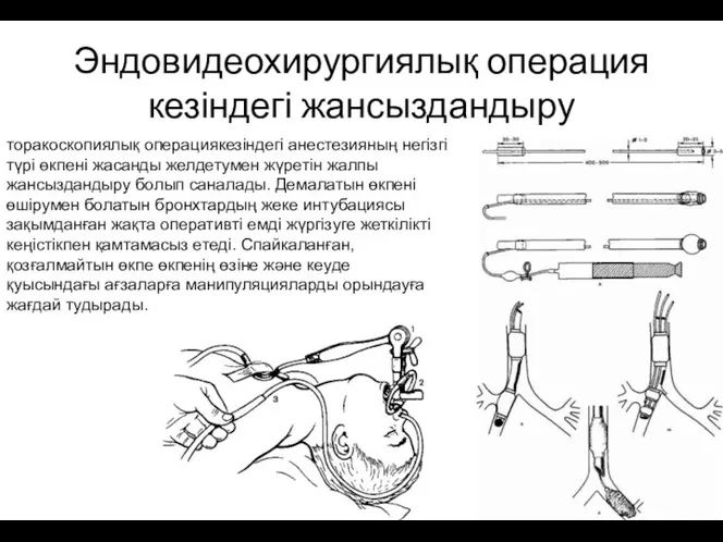 Эндовидеохирургиялық операция кезіндегі жансыздандыру торакоскопиялық операциякезіндегі анестезияның негізгі түрі өкпені