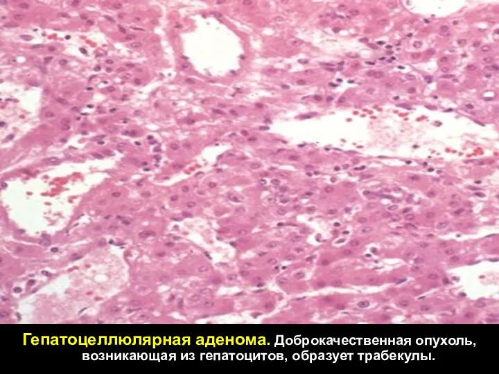 Гепатоцеллюлярная аденома. Доброкачественная опухоль, возникающая из гепатоцитов, образует трабекулы.
