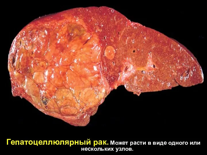 Гепатоцеллюлярный рак. Может расти в виде одного или нескольких узлов.