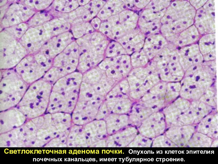 Светлоклеточная аденома почки. Опухоль из клеток эпителия почечных канальцев, имеет тубулярное строение.