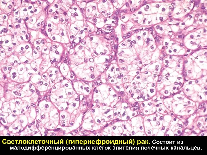 Светлоклеточный (гипернефроидный) рак. Состоит из малодифференцированных клеток эпителия почечных канальцев.
