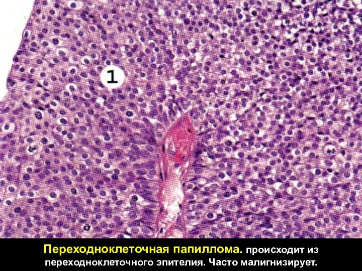 Переходноклеточная папиллома. происходит из переходноклеточного эпителия. Часто малигнизирует.