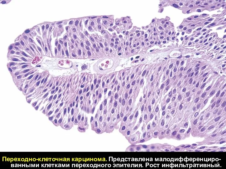 Переходно-клеточная карцинома. Представлена малодифференциро-ванными клетками переходного эпителия. Рост инфильтративный.