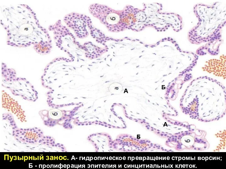 А Б А А Б Б Пузырный занос. А- гидропическое