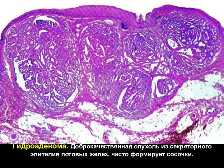 Гидроаденома. Доброкачественная опухоль из секреторного эпителия потовых желез, часто формирует сосочки.