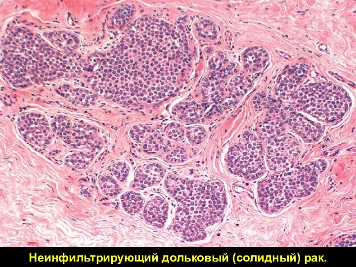 Неинфильтрирующий дольковый (солидный) рак.