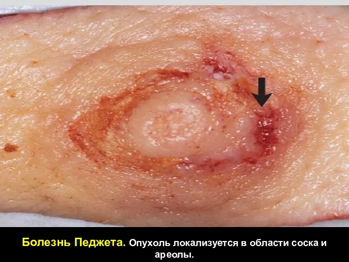 Болезнь Педжета. Опухоль локализуется в области соска и ареолы.