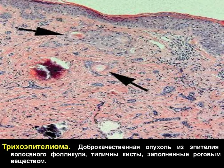 Трихоэпителиома. Доброкачественная опухоль из эпителия волосяного фолликула, типичны кисты, заполненные роговым веществом.