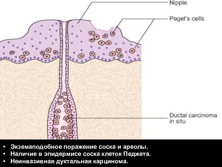 Экземаподобное поражение соска и ареолы. Наличие в эпидермисе соска клеток Педжета. Неинвазивная дуктальная карцинома.