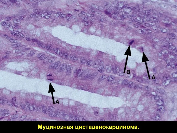 Муцинозная цистаденокарцинома.