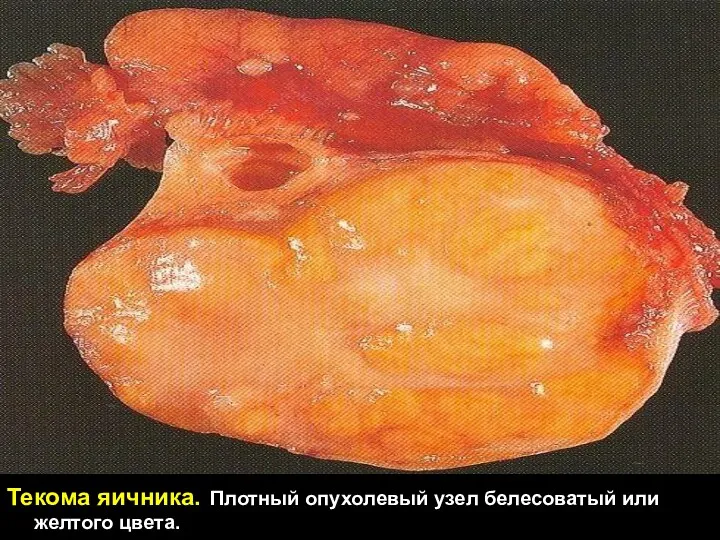 Текома яичника. Плотный опухолевый узел белесоватый или желтого цвета.