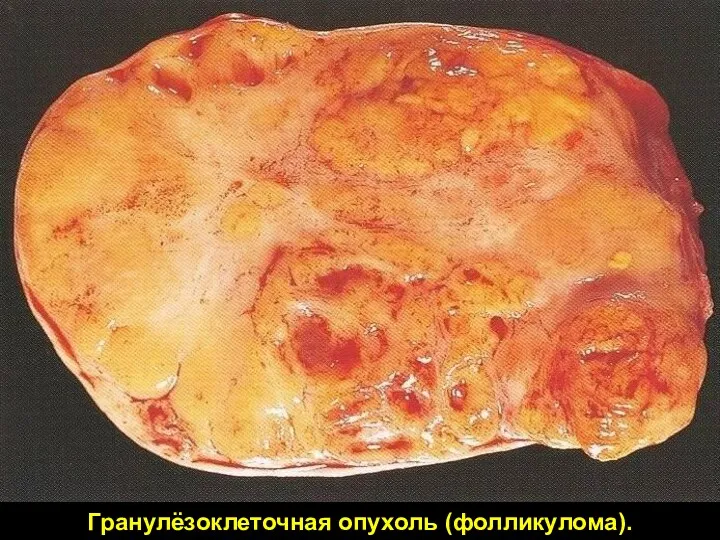 Гранулёзоклеточная опухоль (фолликулома).