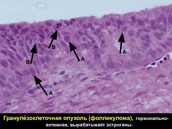 Гранулёзоклеточная опухоль (фолликулома), гормонально-активная, вырабатывает эстрогены.