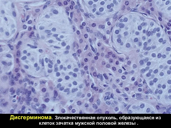 Дисгерминома. Злокачественная опухоль, образующаяся из клеток зачатка мужской половой железы .