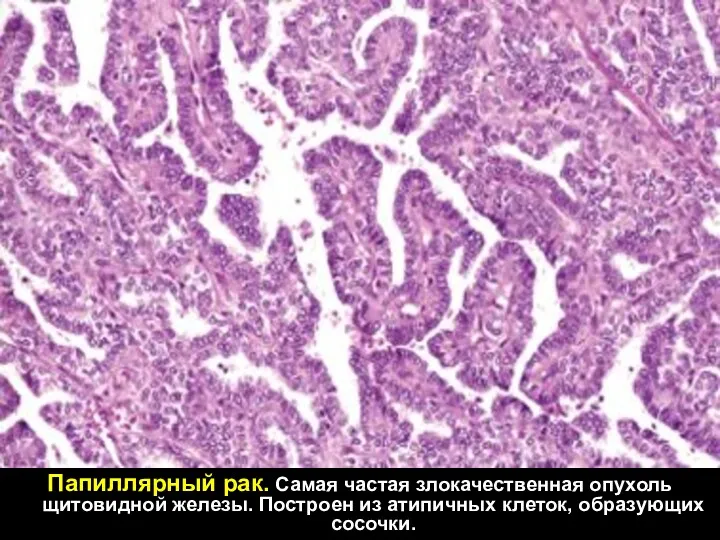 Папиллярный рак. Самая частая злокачественная опухоль щитовидной железы. Построен из атипичных клеток, образующих сосочки.
