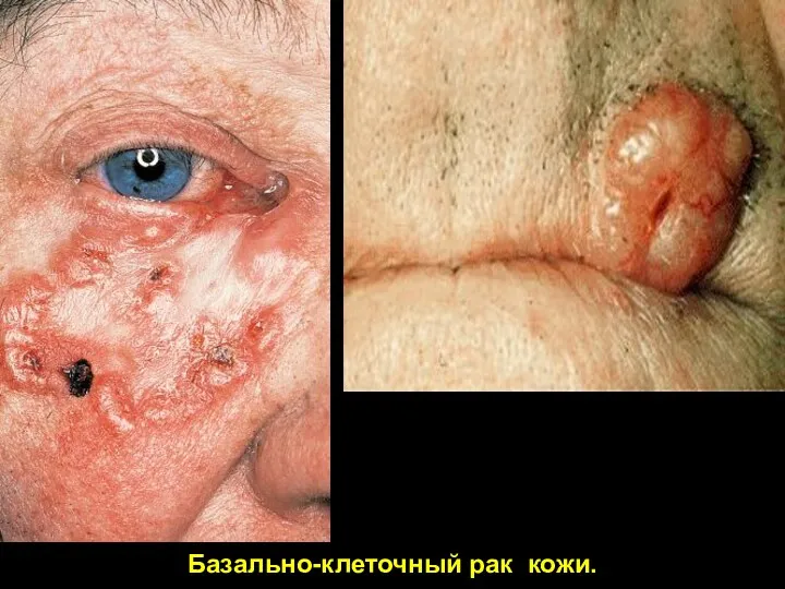 Базально-клеточный рак кожи.