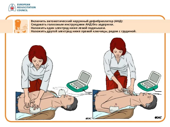 Включить автоматический наружный дефибриллятор (АНД): Следовать голосовым инструкциям АНД без