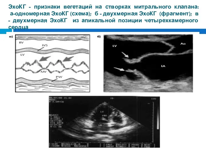 ЭхоКГ - признаки вегетаций на створках митрального клапана: а-одномерная ЭхоКГ