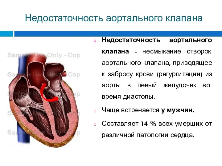 Недостаточность аортального клапана Недостаточность аортального клапана - несмыкание створок аортального