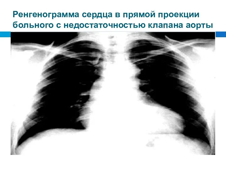 Ренгенограмма сердца в прямой проекции больного с недостаточностью клапана аорты