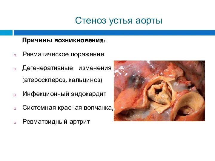 Стеноз устья аорты Причины возникновения: Ревматическое поражение Дегенеративные изменения (атеросклероз,