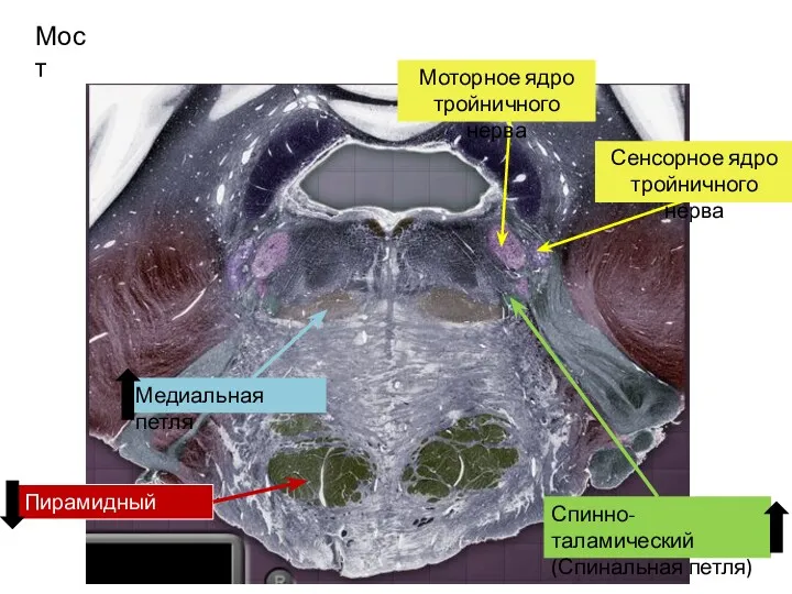Медиальная петля Мост Моторное ядро тройничного нерва Сенсорное ядро тройничного нерва