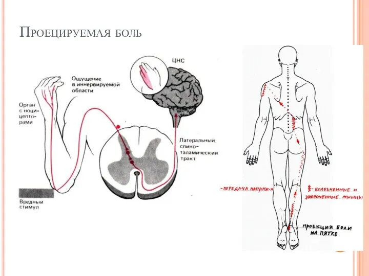 Проецируемая боль