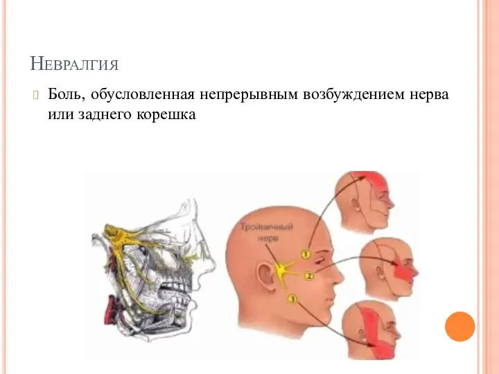 Невралгия Боль, обусловленная непрерывным возбуждением нерва или заднего корешка