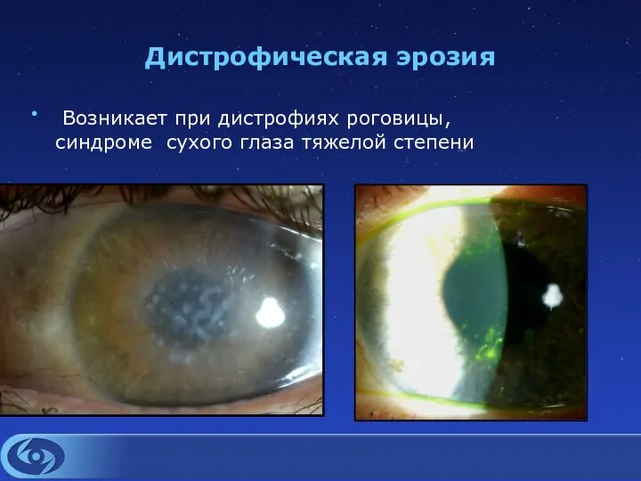 Дистрофическая эрозия • Возникает при дистрофиях роговицы, синдроме сухого глаза тяжелой степени