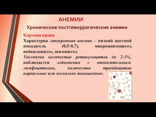 АНЕМИИ Картина крови Характерна гипохромная анемия – низкий цветной показатель