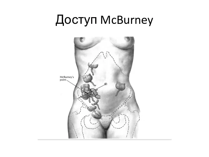 Доступ McBurney