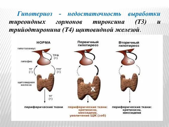 Гипотериоз - недостаточность выработки тиреоидных гормонов тироксина (T3) и трийодтиронина (T4) щитовидной железой.