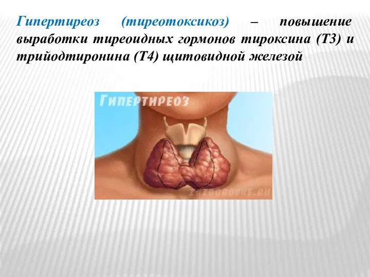 Гипертиреоз (тиреотоксикоз) – повышение выработки тиреоидных гормонов тироксина (T3) и трийодтиронина (T4) щитовидной железой