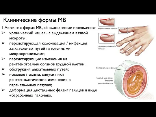 Клинические формы МВ 1.Легочная форма МВ, её клинические проявления: хронический