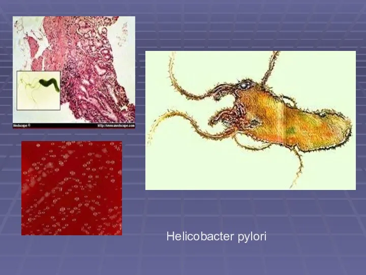 Helicobacter pylori