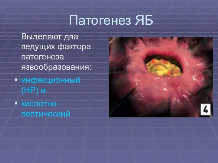 Патогенез ЯБ Выделяют два ведущих фактора патогенеза язвообразования: инфекционный (НР) и кислотно-пептический