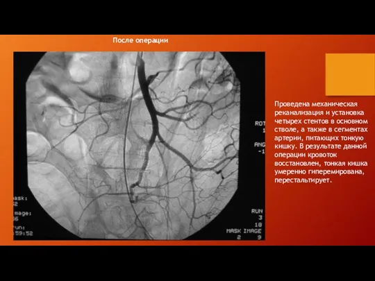 Проведена механическая реканализация и установка четырех стентов в основном стволе,