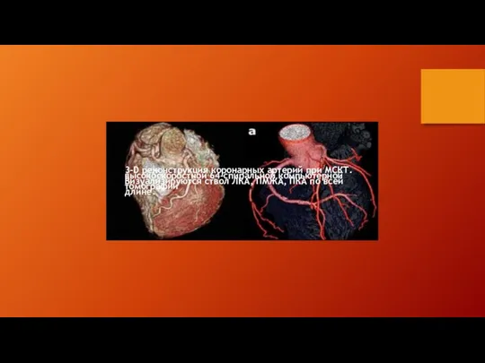 3-D реконструкция коронарных артерий при МСКТ. Визуализируются ствол ЛКА, ПМЖА,